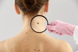 Pencegahan Kanker Kulit yang Merusak Sel kulit